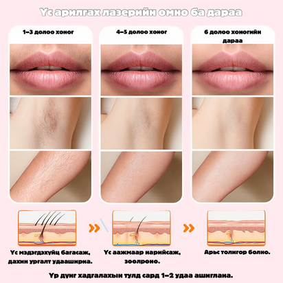 IPL лазер үс арилгах төхөөрөмж